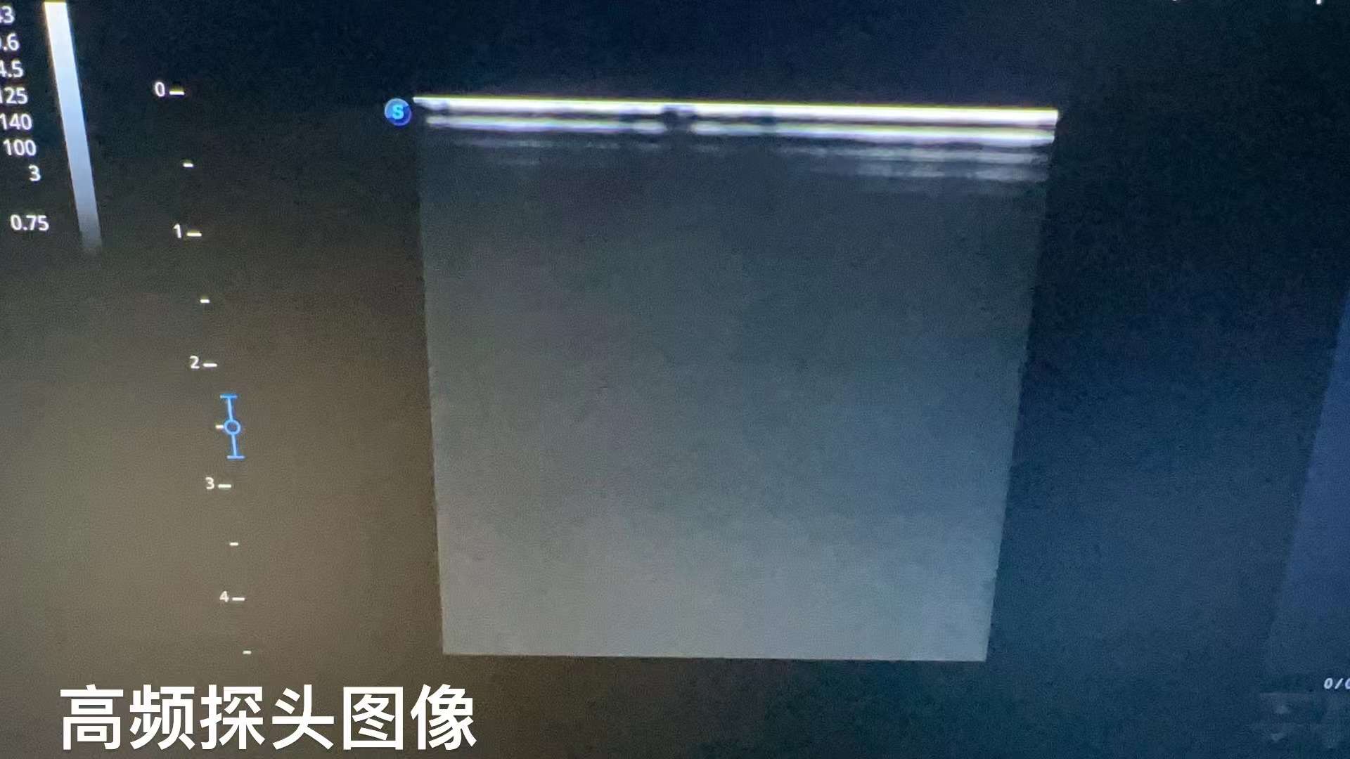 開立 SonoScape B超探頭問題如下：1.高頻探頭老化，圖像顯示不清2.陰超探頭鼓包，手按壓鼓包處，黑影會(huì)隨之移動(dòng)變化