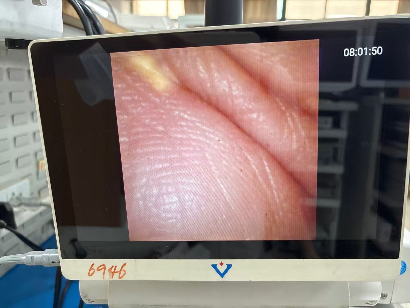 支气管镜图像反光