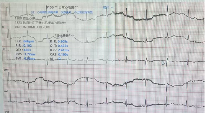 維修NIHON KOHDEN 日本光電cardiofaxS 心電圖機ECG-2250 顯示屏幕故障，心電波形有干擾。